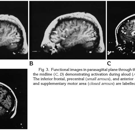 Functional images in parasagittal plane through the left hemisphere (... | Download Scientific ...