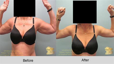 The "Invisible" Arm-Lift Procedure | Imagine Plastic Surgery