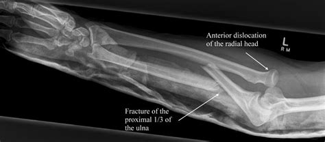 Monteggia fx fx of proximal ulna with dislocation of radius | Radiography, Muscle anatomy ...