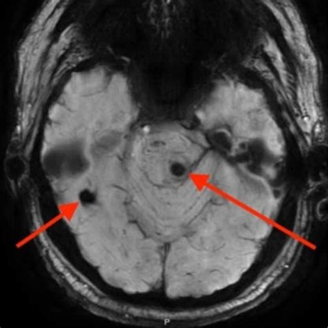 MRI SWI sequence showing multiple areas of hemosiderin deposition... | Download Scientific Diagram