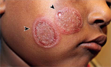 An Unusual Inflammatory Rash | Dermatology | JAMA Pediatrics | The JAMA ...