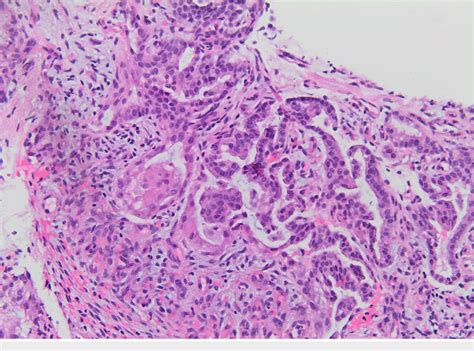 Examination of the lung biopsy. The lung biopsy revealed a tumor ...