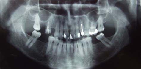 Dental Radiographs | Skygate Dental