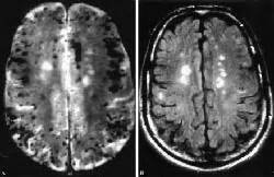 What is Vascular Dementia? – Aspen Senior Day Center