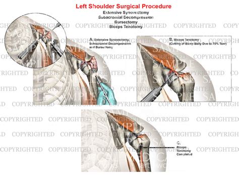 Left shoulder surgery - Synovectomy - Bursectomy - Debridement of RC tear - Subacromial ...