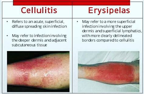 Cellulitis vs erysipelas - MEDizzy