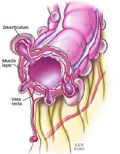 Vasa Recta Diverticulosis