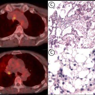 In A, axial CT scans of the chest showing a crazy-paving pattern in the... | Download Scientific ...