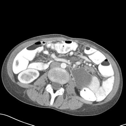 Closed loop obstruction | Radiology Case | Radiopaedia.org