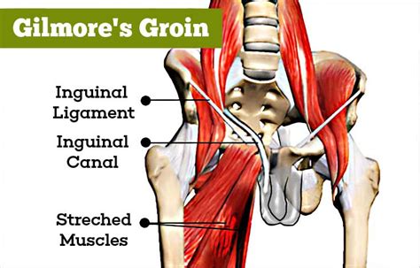 Gilmore’s Groin - Causes, Symptoms, Signs, Diagnosis, Treatment