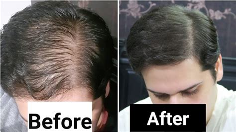 Rosemary Oil for Hair Growth Before and After: Does it Really Work? | UPGUYS