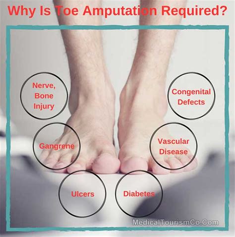 Why is Toe Amputation Required