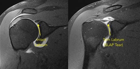 SLAP Tears and Biceps Tendon Injuries — Huang Orthopaedics