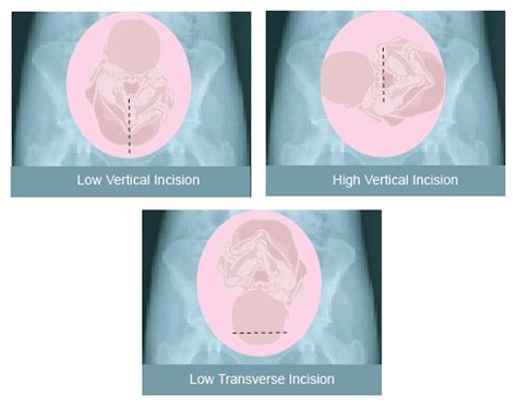 VBAC Vaginal Birth After Cesarean | classical transverse, low vertical