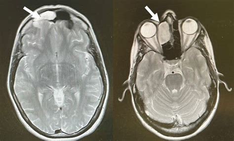 , 2. Cerebral and sinuses MRI demonstrating opacified right frontal ...