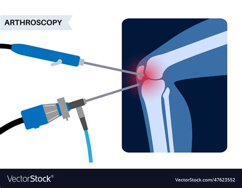 Knee joint arthroscopy Royalty Free Vector Image