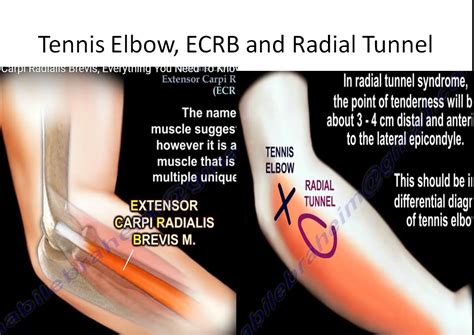 Tennis Elbow, ECRB and Radial Tunnel Syndrome — OrthopaedicPrinciples.com