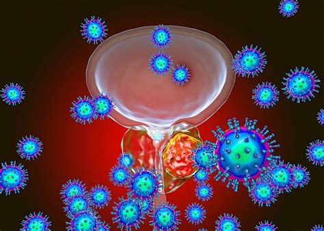 Urine biomarker to determine prognosis in prostate cancer - East Anglia study - Juta MedicalBrief