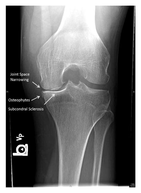 Examples of JSN, osteophytes, and subchondral sclerosis on a tunnel... | Download Scientific Diagram