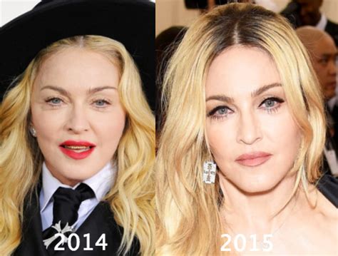 Madonna Plastic Surgery Before and After Photos