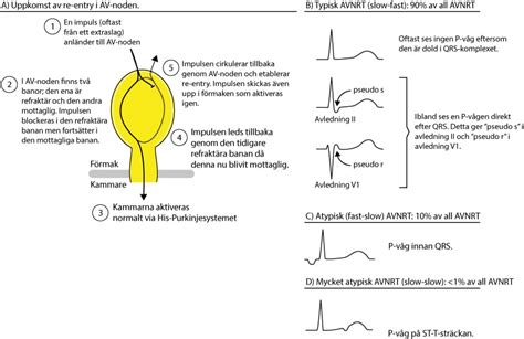 AVNRT – ECG learning