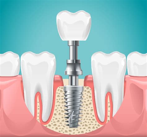 The Advantages and Disadvantages of Zirconia Dental Implants