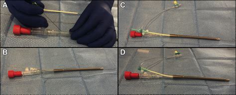 Inferior Vena Cava Filter Placement Through a Venovenous Extracorporeal ...