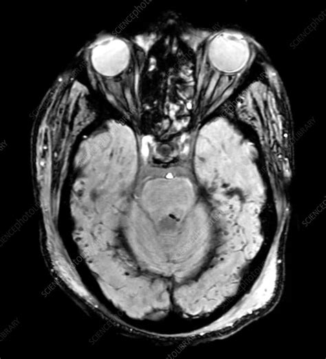 Traumatic Brain Injury MRI - Stock Image - C043/2966 - Science Photo Library