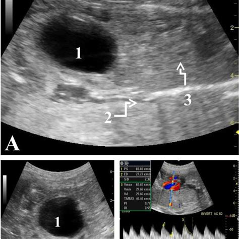 Prenatal ultrasound findings of a case of prune-belly syndrome in Papua ...