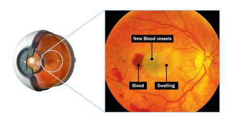 Macular Degeneration – Eye Doctors Mona Vale