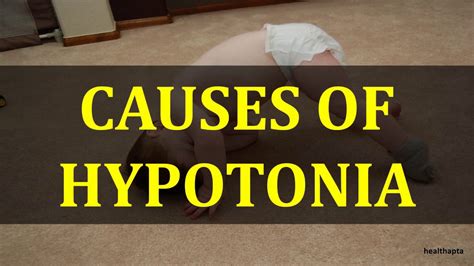 CAUSES OF HYPOTONIA - YouTube