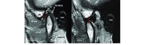 Anatomy of the TMJ demonstrated by MRI. Closed-mouth proton density and ...