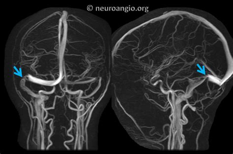 Pulsatile Tinnitus Venous Sinus Stenosis | neuroangio.org