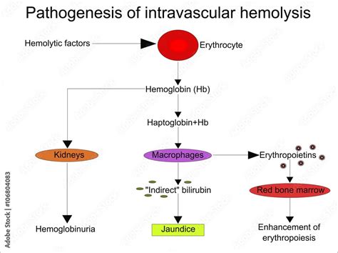 Pathogenesis of intravascular hemolysis Stock Vector | Adobe Stock