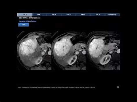 Hepatic Focal Lesions : Tire I - YouTube