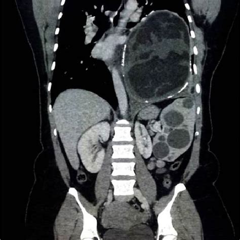 Sagittal view of CT scan of the chest/abdomen/pelvis. | Download ...