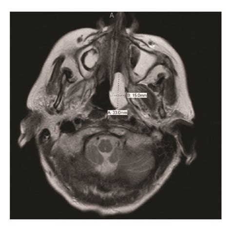 MRI brain: three abnormal bone marrow lesions (left clivus, right... | Download Scientific Diagram