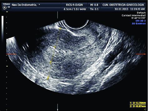 Normal Uterus Measurements Ultrasound