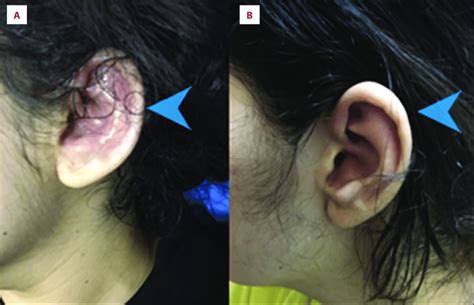 (A) Auricular perichondritis involving the cartilaginous portion of the ...