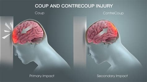 Coup Contrecoup Injury - Scientific Animations