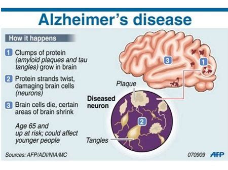 Alzheimer's Project - 5-M. Charlene Biology Portfolio