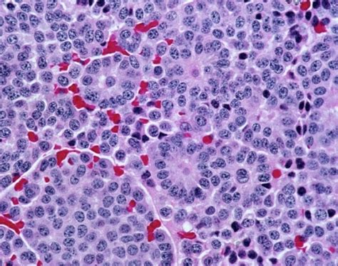 Lung NETs and Their Treatment - Cancer Commons