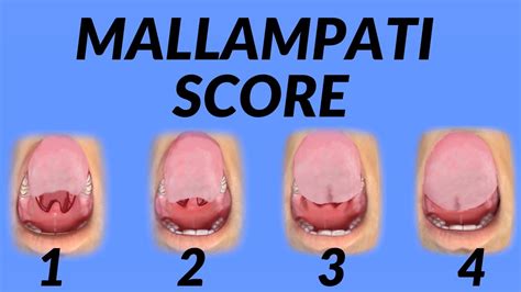 Mallampati Score (Airway Assessment Technique) Animation - YouTube