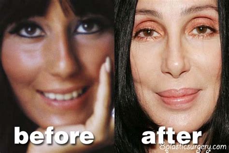 Cher ~ 100 plastic surgery