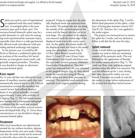 An 11-year-old patient with luxated tooth No. 9. Fig. 2. A radiograph... | Download Scientific ...