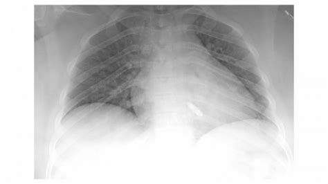 Leadless Pacemaker Implant Procedure Available