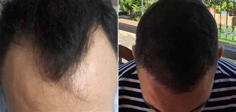 Before and after hair transplant: Step-by-Step Situation - RepHair