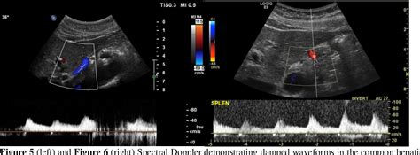 Figure 5 from Median Arcuate Ligament Syndrome Confirmed With Vascular Ultrasound | Semantic Scholar