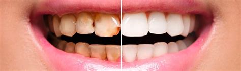 Full mouth dental reconstruction before and after photos - Dentakay