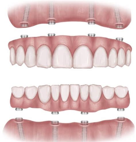 All-on-4 Dental Implants: FAQs and Information